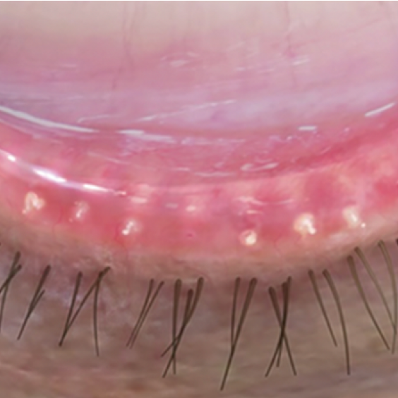 Eyelid with moderate meibomian gland dysfunction