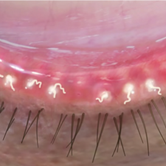 Eyelid with severely blocked meibomian glands